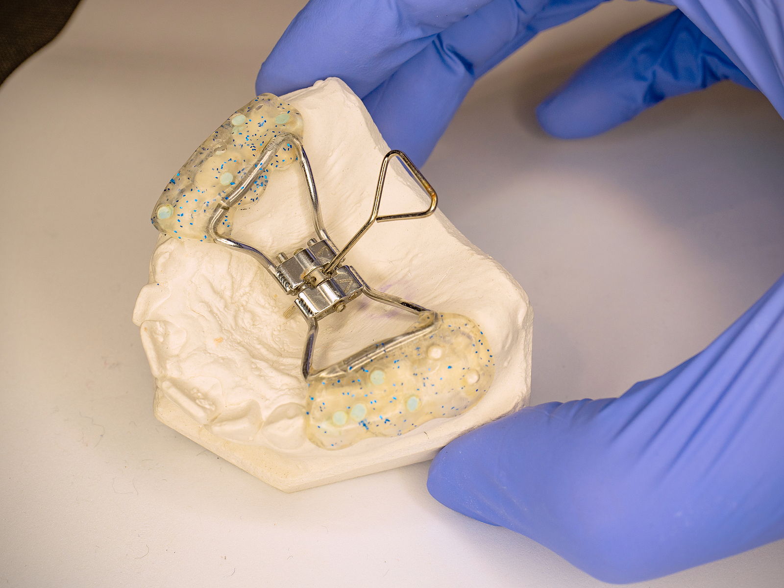 Palatal Expander Palatal Expander